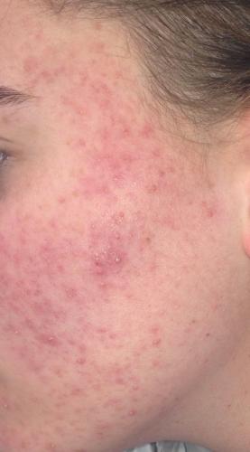 Acne Or Rosacea Help Rosacea And Facial Redness Community
