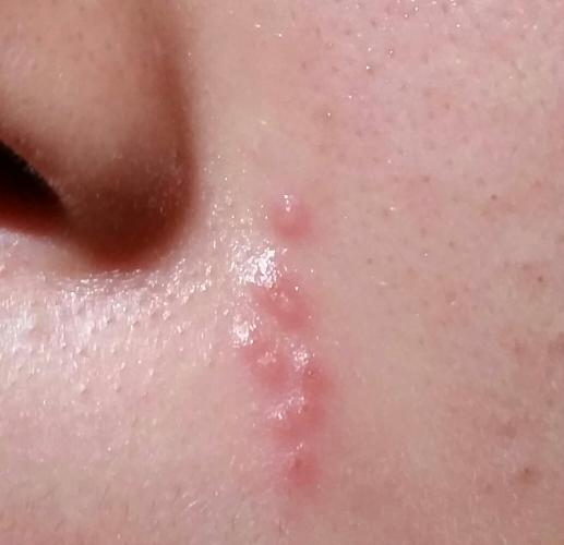 herpes or pimple