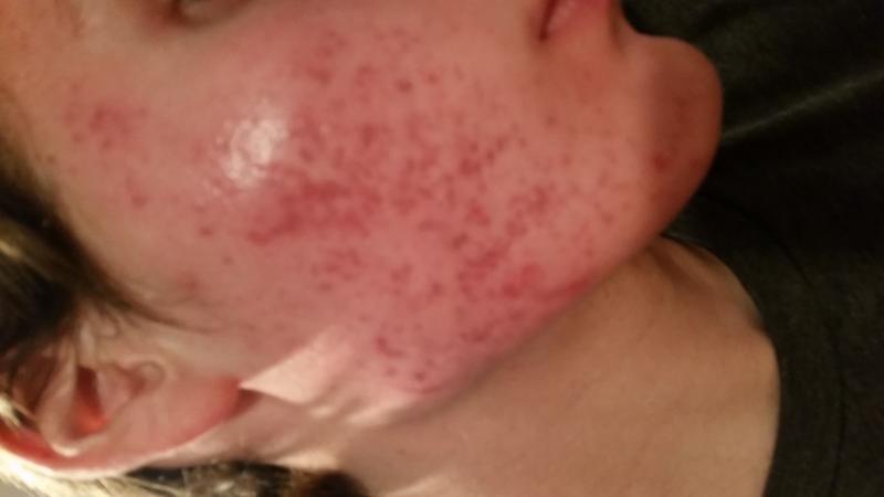 Acne Red Marks That Won t Go Away Hyperpigmentation Red dark Marks 