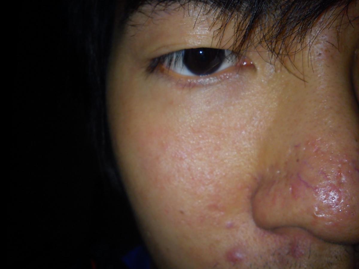 Ice Pick Scars On Nose With Pictures - Scar treatments - by fierywinds