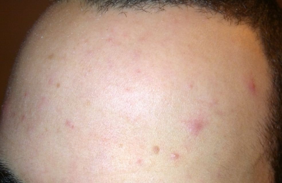 Persistent Forehead Only Acnefolliculitis Pics General Acne