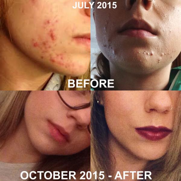 acne success story